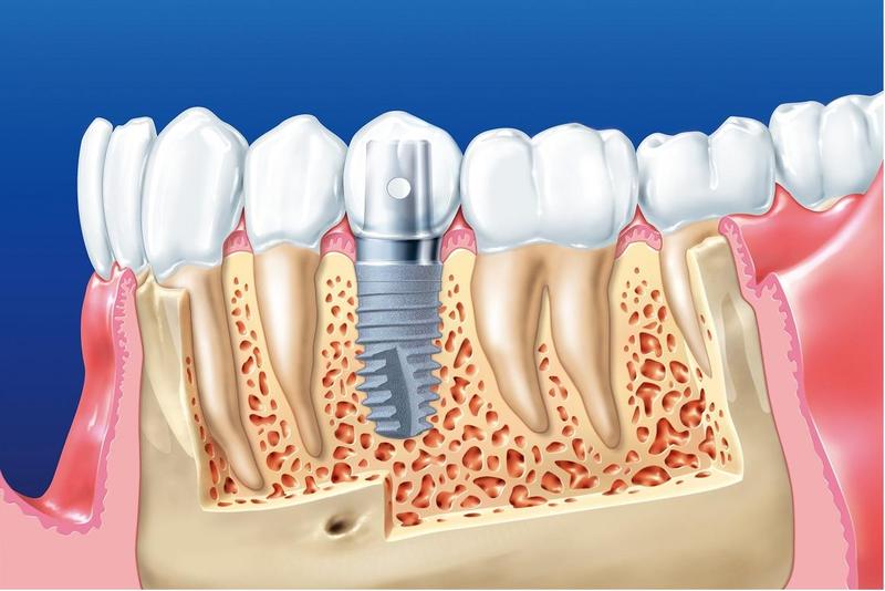 trồng răng implant tại TPHCM