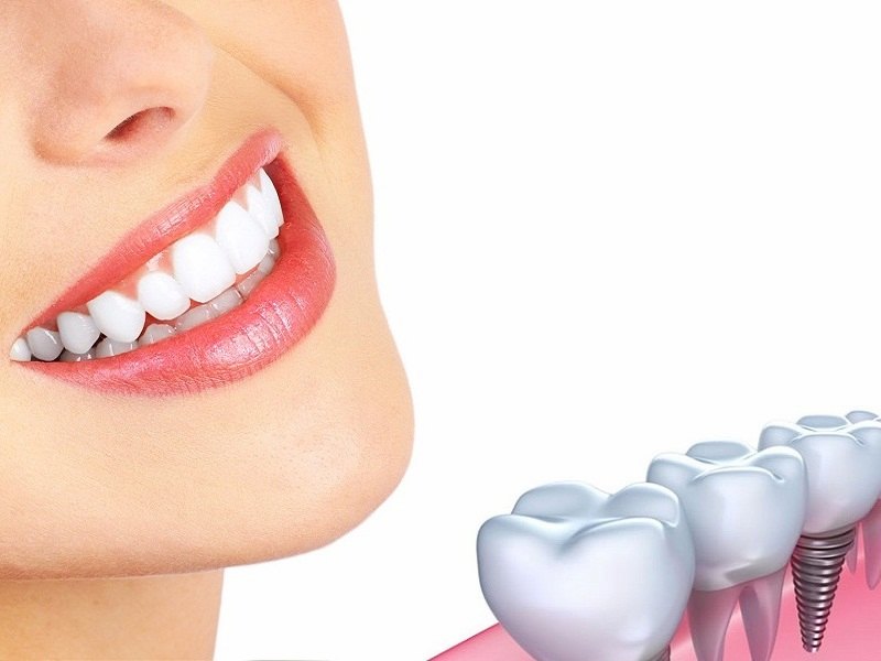 trồng răng implant tại TPHCM