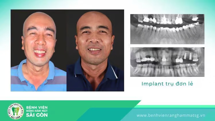 Cấy Răng Implant Là Gì